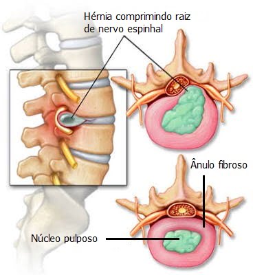 esquema hernia de disco