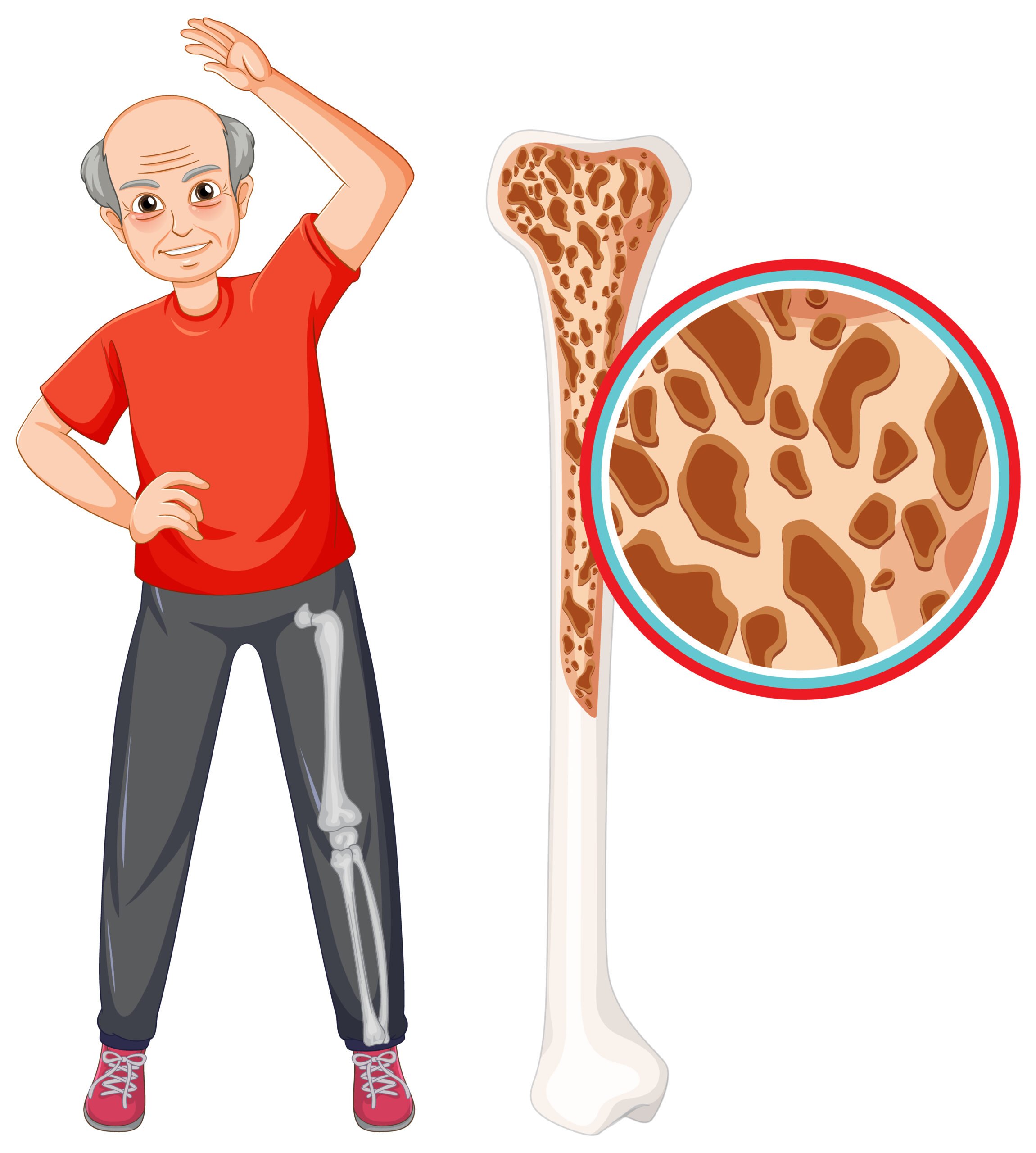 idoso + esquema osteoporose